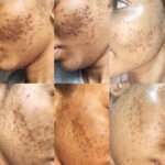 Isichitho Pimples